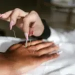 A detailed view of an acupuncture session for holistic health and wellness.